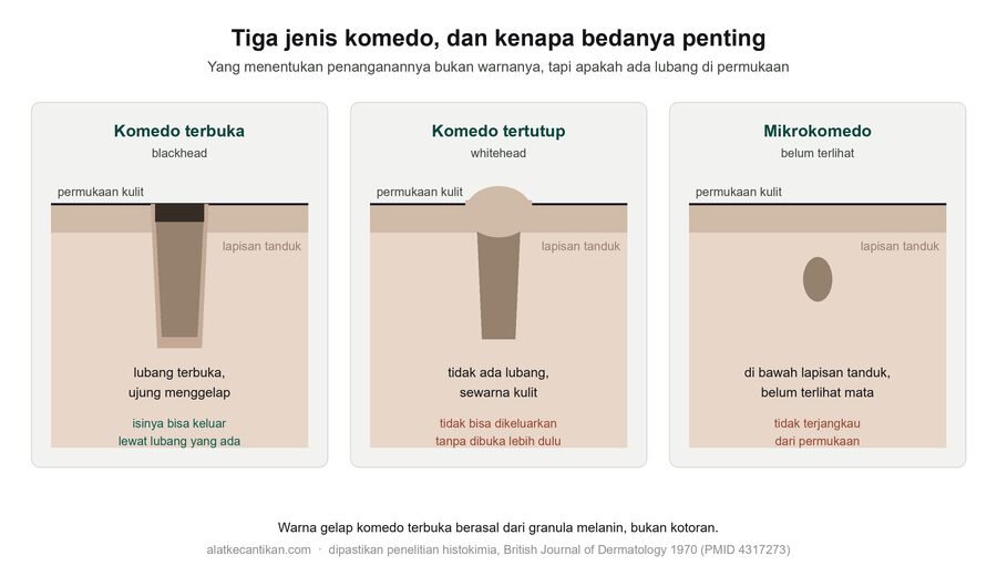 Diagram tiga jenis komedo: komedo terbuka dengan lubang di permukaan dan ujung menggelap, komedo tertutup tanpa lubang, dan mikrokomedo di bawah lapisan tanduk